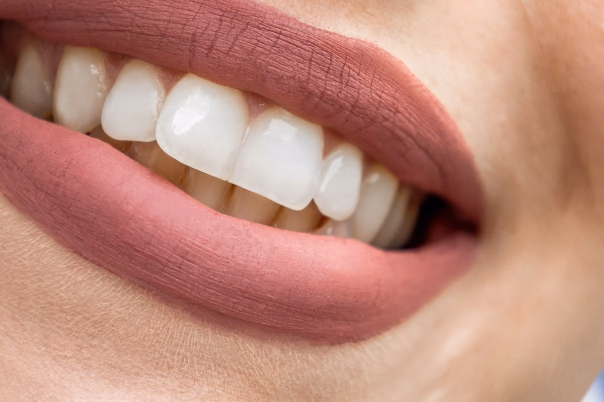 Resultado de lentes de contato dental